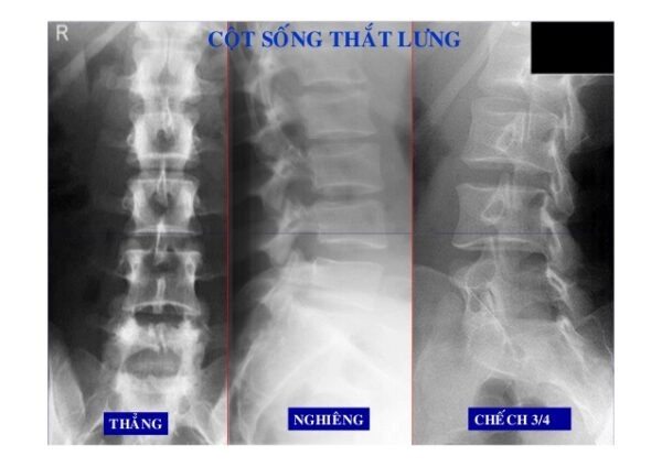 chụp x quang cột sống thắt lưng các tư thế