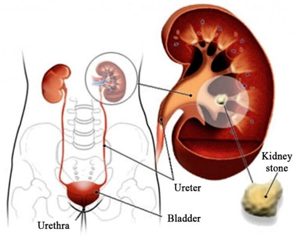 Cần nhận biết dấu hiệu sỏi tiết niệu từ sớm để diều trị kịp thời