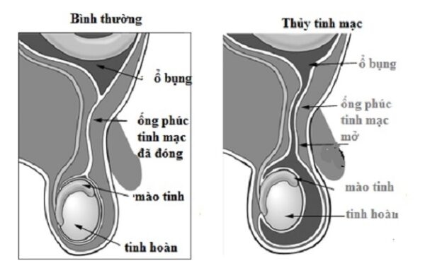 siêu âm bẹn bìu giúp chẩn đoán thoát vị bẹn ở trẻ