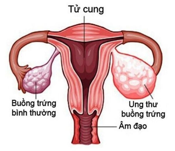 tầm soát buồng trứng
