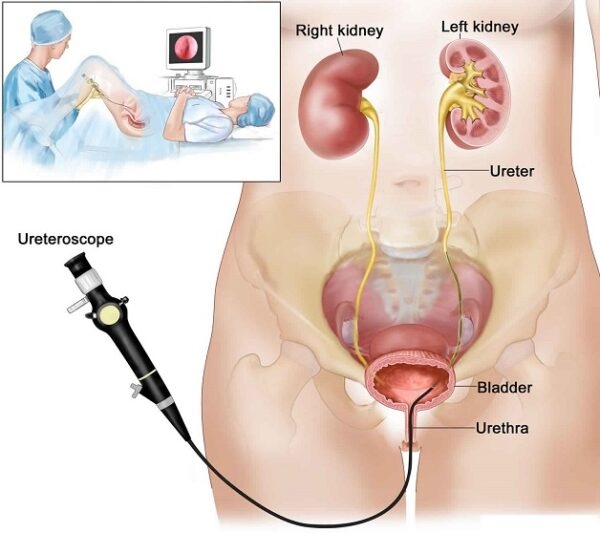 Kỹ thuật tán sỏi thận ngược dòng sử dụng ống soi niệu quản đi từ vùng niệu đạo, qua bàng quang lên niệu quản và đến thận