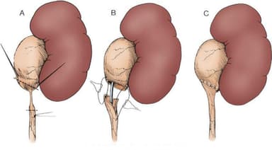 Những điều cần biết về tạo hình khúc nối bể thận niệu quản