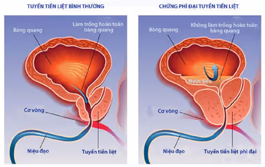 U xơ phì đại tuyến tiền liệt – nỗi lo của nam giới