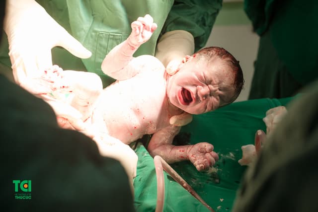 Cận cảnh ca mổ dây rốn thắt nút tại Bệnh viện Thu Cúc