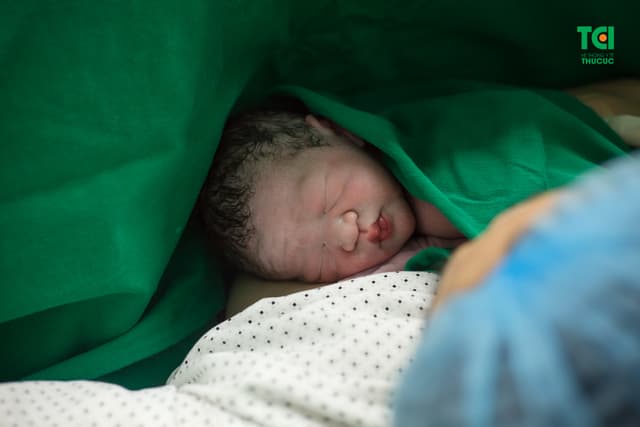 Cận cảnh ca mổ dây rốn thắt nút tại Bệnh viện Thu Cúc