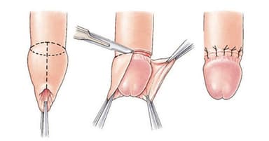 Giải đáp hết thắc mắc về phẫu thuật cắt bao quy đầu