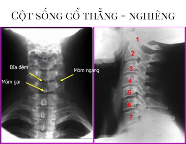 phương pháp chụp x quang cột sống cổ