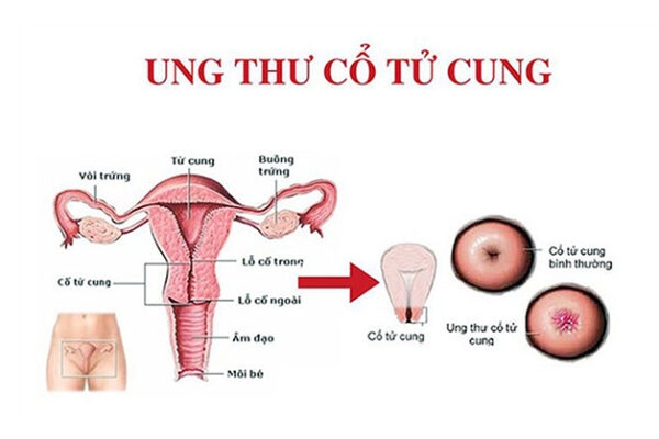 Địa chỉ sàng lọc ung thư cổ tử cung uy tín