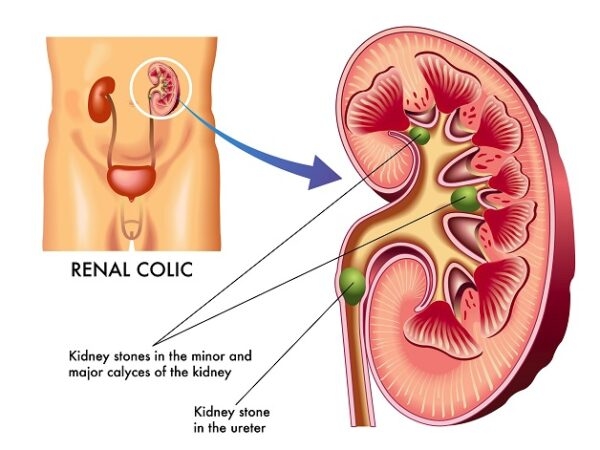 Có thể có một hoặc nhiều viên sỏi thận rơi xuống đường tiết niệu