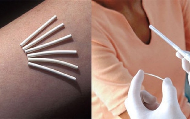 Thời điểm tốt nhất để cấy que tránh thai sau sinh là 6 tuần sau khi sinh
