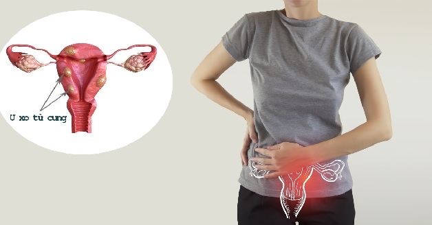U xơ tử cung là căn bệnh phổ biến nhiều chị em gặp phải