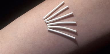 Cấy que tránh thai bị rong kinh ảnh hưởng thế nào tới chị em