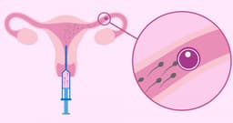 IUI là phương pháp gì và quá trình làm IUI như thế nào?