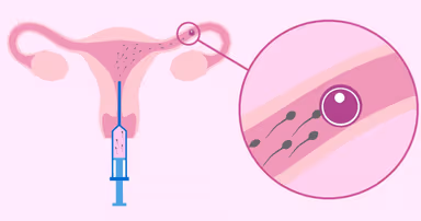 IUI là phương pháp gì và quá trình làm IUI như thế nào?