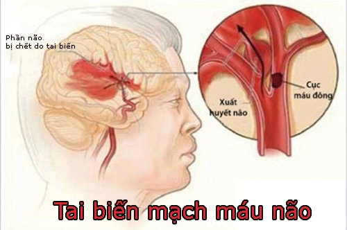 thiếu máu não cục bộ thoáng qua gây tai biến mạch máu não