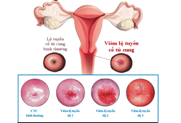 Viêm cổ tử cung được chia làm 3 cấp độ trong đó cấp độ 3 là nghiêm trọng nhất, vùng lộ tuyến bị viêm cổ tử cung nặng