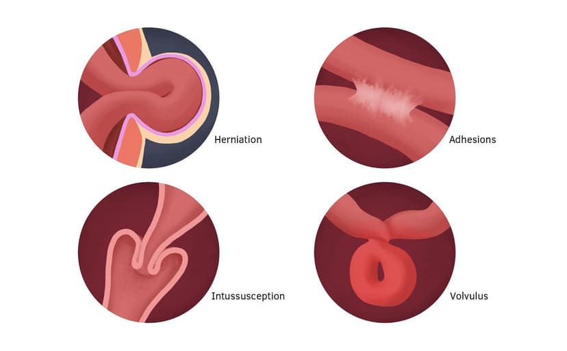 Triệu chứng cảnh báo bị tắc ruột, cách chẩn đoán và điều trị
