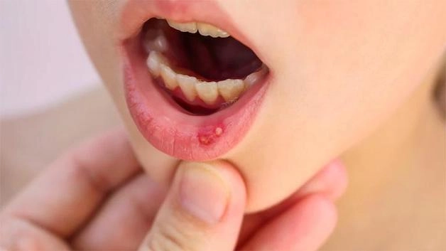 khắc phục tình trạng bị nhiệt miệng