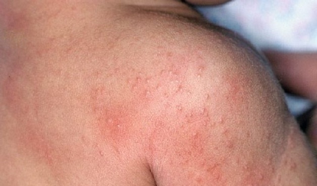 Những vết sần đỏ là dấu hiệu trẻ bị rôm sảy