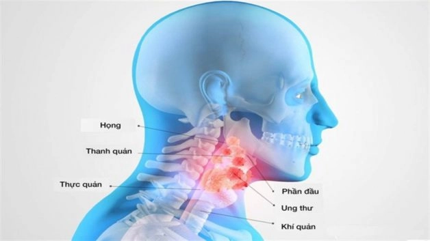 Viêm họng nổi hạch nên làm gì để hết triệu chứng