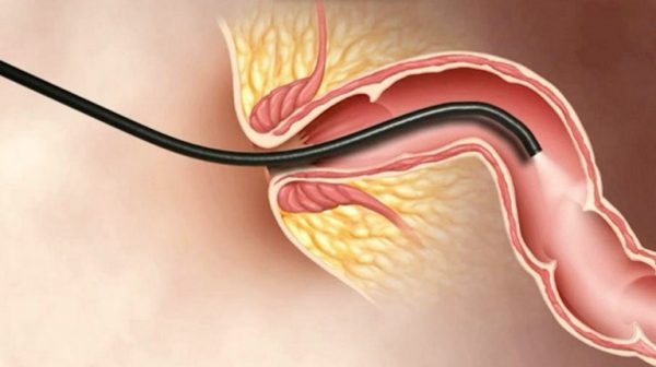 Phương pháp nội soi được chỉ định trong viêm loét đại trực tràng chảy máu
