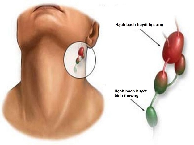 Dấu hiệu ung thư vòm họng - Hạch bạch huyết sưng