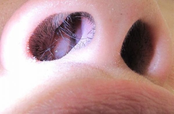 bệnh polyp mũi là gì