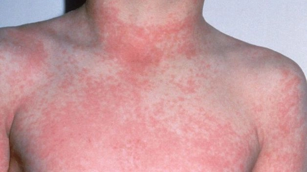 xét nghiệm sốt virus