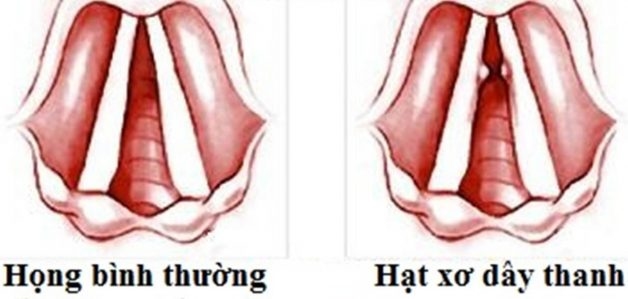 Những nguyên nhân gây khàn tiếng kéo dài