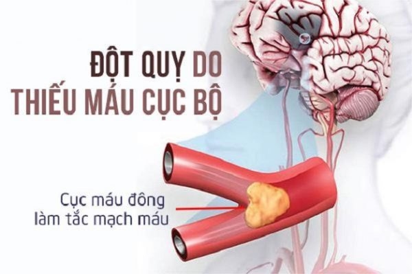 thiếu máu lên não là bệnh lý tiền đột quỵ