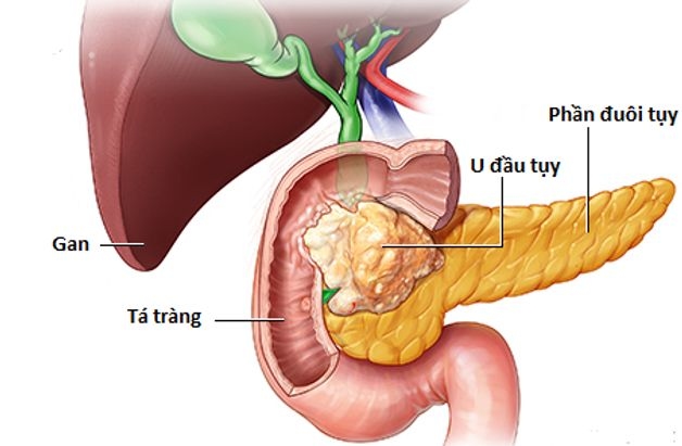 triệu chứng ung thư tụy ngoại tiết