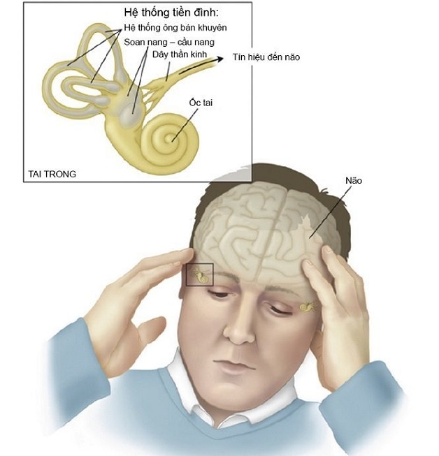 các triệu chứng của hội chứng rối loạn tiền đình