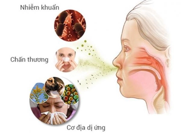 viêm mũi dị ứng