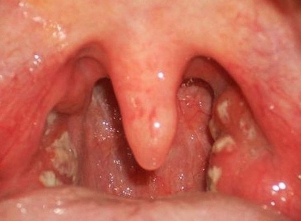 viêm họng mủ ở trẻ em