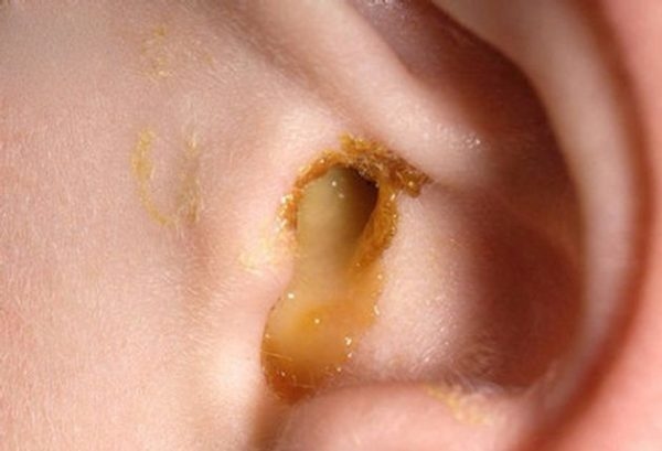 viêm họng có mủ ở trẻ