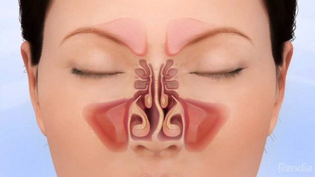 Những vấn đề bệnh nhân cần biết trước khi mổ vẹo vách ngăn