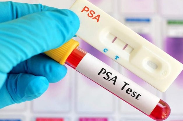 Quy trình thực hiện xét nghiệm PSA