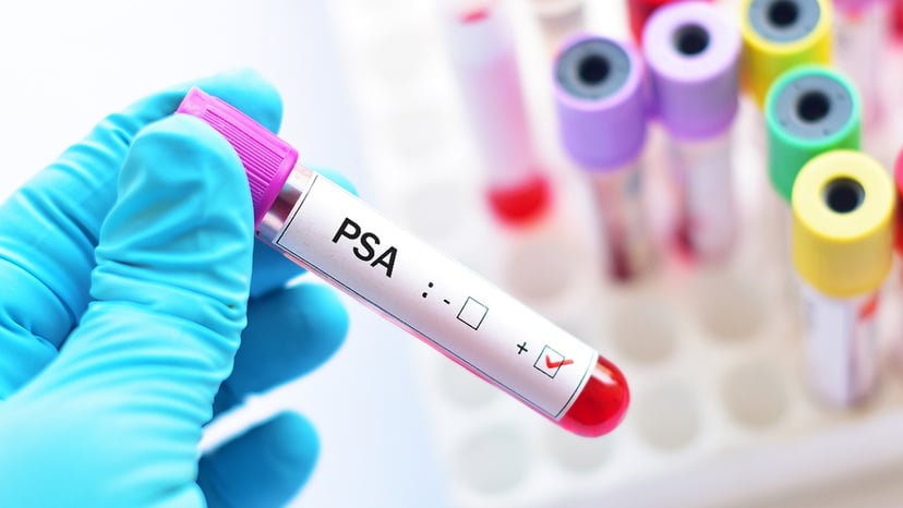 Tương quan giữa xét nghiệm PSA và ung thư tuyến tiền liệt