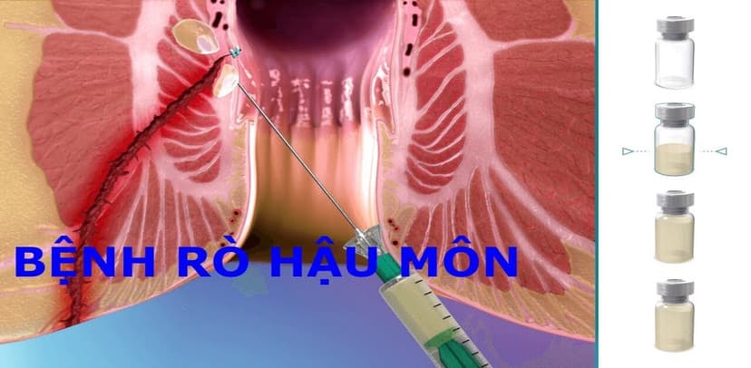 Rò hậu môn: Phân loại, nguyên nhân, biểu hiện lâm sàng và điều trị