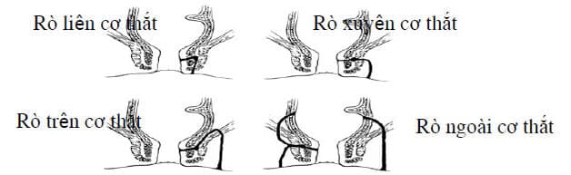 Phân loại các dạng rò hậu môn
