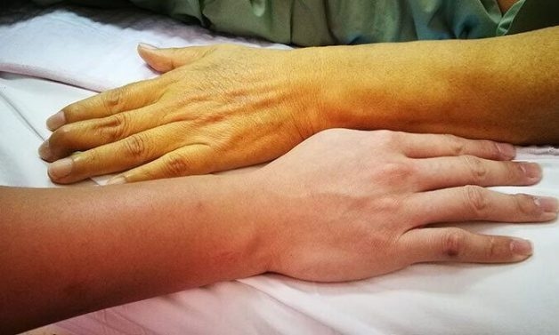 Ung thư tụy giai đoạn cuối sống được bao lâu?