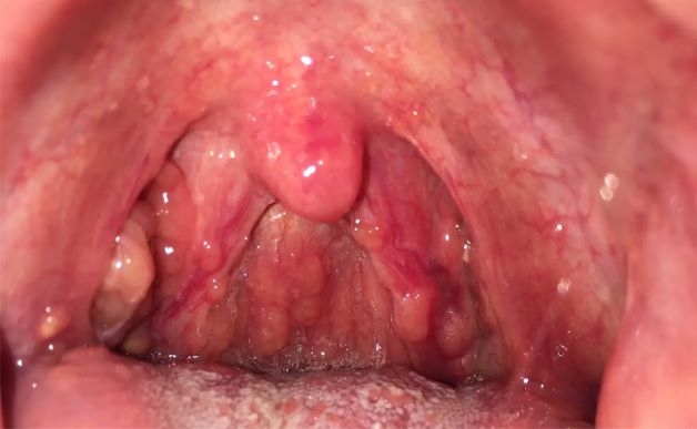 Viêm amidan nên ăn gì?