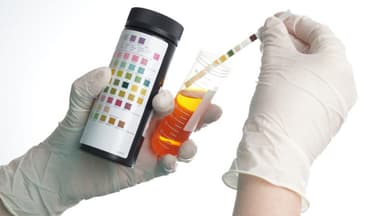 Xét nghiệm acid uric trong nước tiểu và những điều cần biết