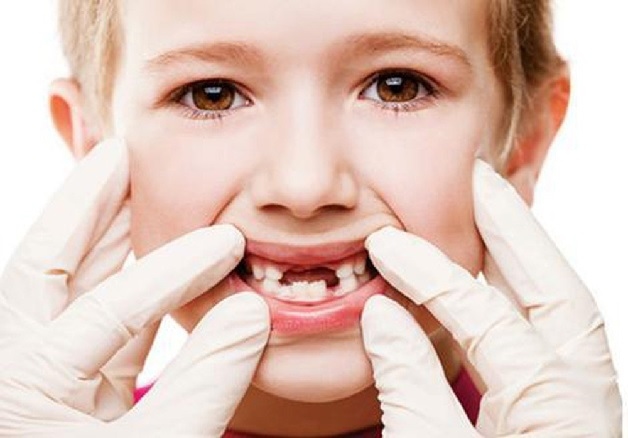 Có rất nhiều nguyên nhân khiến trẻ 6 tuổi bị sâu răng