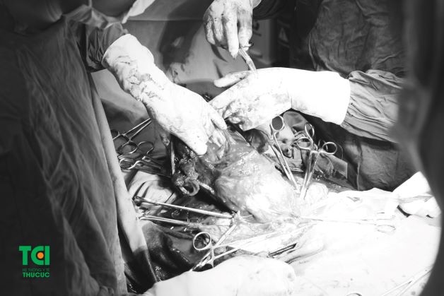 Hình ảnh rau tiền đạo trung tâm kèm rau cài răng lược của chị Vui trong quá trình phẫu thuật