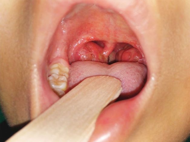 Viêm họng trắng