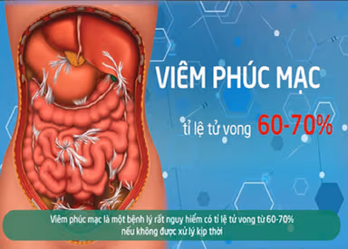 Viêm phúc mạc bệnh học: nguy cơ gây tử vong cao