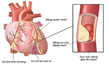 Tắc mạch vành tim: Nguyên nhân, triệu chứng, điều trị