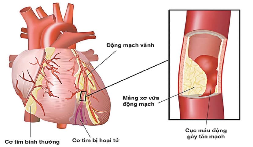 Tắc mạch vành tim: Nguyên nhân, triệu chứng, điều trị