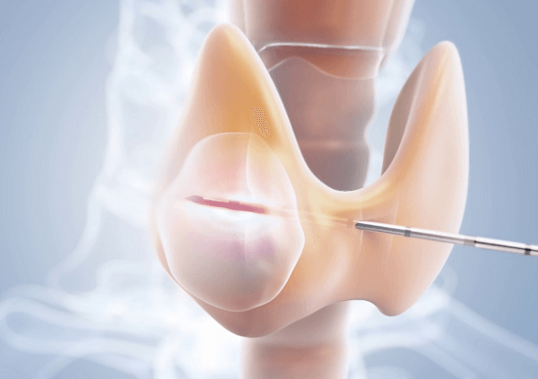 Sử dụng đầu kim của máy đốt sóng cao tần tiếp cận và tiêu diệt khối u lành tuyến giáp